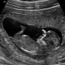 The amount of fluid is measured during a nuchal translucency (nt) ultrasound scan: Week 12 Ultrasound What It Would Look Like Parents