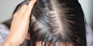 اسباب تساقط الشعر عند النساء وعلاجه