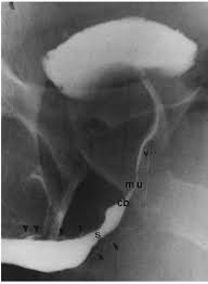 Image result for Retrograde Urethrogram