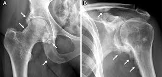 Image result for periostitis