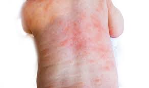 Image result for sweat rash on back baby