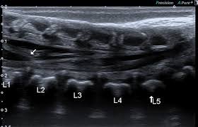 Image result for Spinal Dysraphism