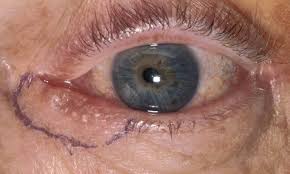 Bosartige Tumoren Der Augenlider Das Elza Institut