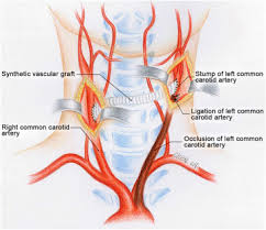 The arteria profunda linguæ ( ranine artery; Carotid Carotid Artery Crossover Bypass With A Synthetic Vascular Graft For Symptomatic Type 1a Common Carotid Artery Occlusion Sciencedirect