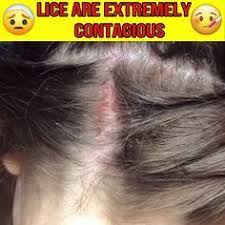 Top 10 Natural Home Remedies For Dandruff Health Life 2020 In 2020 Natural Asthma Remedies Louse Hair Lice