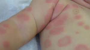 Image result for Erythema Multiforme Major