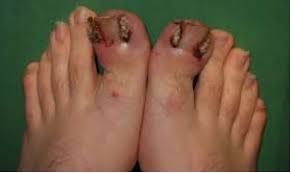 Image result for Paronychia feet
