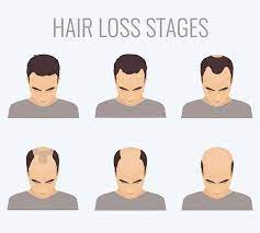 Dht is the main culprit in hair loss. How Long Does It Take To Go Bald The Definitive Answer For Every Guy
