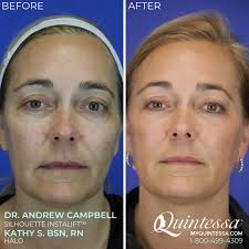 ✨ INSTALIFT & HALO ✨...