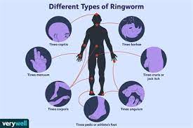 Everyone on here is quoting that hand ringworm is caused by a fungus, like a mushroom and is not a bacteria so the hand sanitizer won't cure it. Does Hand Sanitizer Kill Ringworm Does Hand Sanitizer Kill Ringworm On Skin Bath And Body Hand Sanitizer With Anti Bacterial To Kill Germs Viruses Ssayt