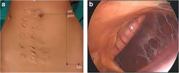 The first port entry in patient who underwent previous abdominal surgery. A Retrospective Study Of A Novel Non Umbilical Laparoscopic Entry Port In Thin Patients Jain Point Gynecological Surgery Full Text