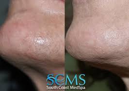 Popular removal methods, like tweezing, waxing, and shaving may all cause damage to the. Laser Hair Removal Los Angeles Laser Hair Removal Orange County Body Hair Removal Laser Acne Scar Removal Laser Tattoo Removal South Coast Medspa Clinic