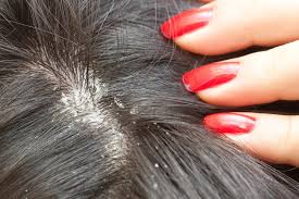 Image result for lice vs dandruff