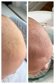 For persistent cases, a doctor may prescribe medicated shampoos or creams. How To Get Rid Of Cradle Cap Naturally Lovely Lucky Life