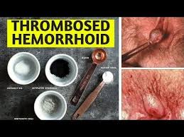 How To Shrink A Thrombosed Hemorrhoid Fast Without Surgery Home Remedies You Getting Rid Of Hemorrhoids Home Remedies For Hemorrhoids Hemorrhoids Treatment