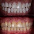Scaling / Teeth Cleaning by Best / Top Dentist Near me product image