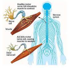 Als disease pathology and proposed disease mechanisms.— proposed disease mechanisms contributing to motor neuron degeneration are: Researchers Close To Understanding Disease Mechanisms Of Als