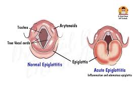 Image result for Acute Laryngitis
