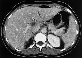John Libbey Eurotext Medecine Therapeutique Thrombose Septique De La Veine Porte