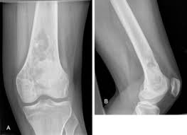 Image result for Leiomyosarcoma