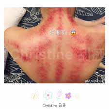 Jump to navigation jump to search. æœ€è¿'èƒŒå¾Œå…©å´éƒ½è¦ºå¾—å¾ˆç— ç—› çœŸçš„å—ä¸äº†é‚„è²¼è—¥è†å¸ƒèˆ'ç·©å…ˆ Christine åˆ®ç—§beaute Angel Facebook