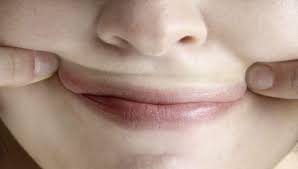 Éstos incluyen medicamentos anti herpes y varias clases de tratamientos para dolor. Ausdruck Eines Geschwachten Immunsystems