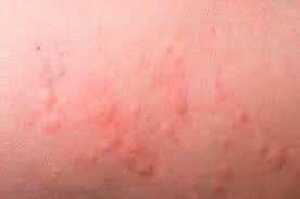 Tedavisi için dermatolog doktoruna gidilmesi gerekiyor. Urtiker Nedir Urtiker Hastaligi Nedir Urtiker Gen Tr