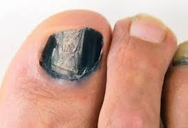 White spots on toenails is quite common among many people. Foot Problems Why Are My Toenails That Color