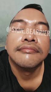 Buat kalian yang penasaran sama mukaku yg sekarang, bisa liat foto ini...  Ini udah pake tretinoin 7 bulanan mungkin wkwk sama pake serum dan basic  skincare... 😁😁 *disclaimer wkwk kulit ku emang