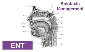Image result for Epistaxis