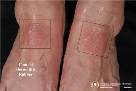 Image result for contact dermatitis