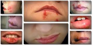 Dermatologists and veteran skin specialists state that cold sore is usually caused by poor standard how i was able to get ride of cold sores fast and permanently for life. Get Rid Of Cold Sores Fast Publications Facebook