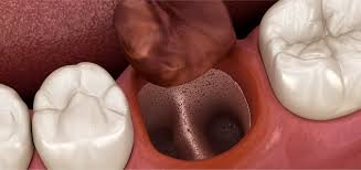 Image result for Alveolitis sicca)