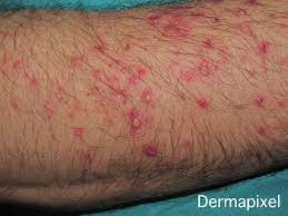 Dermapixel Granos En Los Brazos