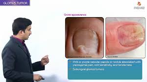 Image result for Glomus tumor