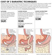 Chirurgie Bariatrique Exemple De Cout Aux Usa Operation Seulement En Polynesie Multipliez Par 2 V Sleeve Surgery Bariatric Surgery Recipes Bariatric Surgery