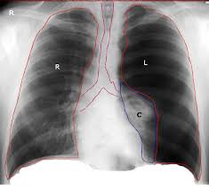 Image result for Pneumothorax