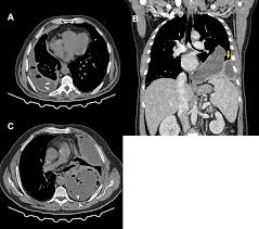 Loculated pleural effusion radiology ct. Recent Insights In The Management Of Pleural Infection Ijgm