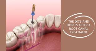 Root canal treatment involves the cleansing of root canal system with dental files and disinfectant agent. The Do S And Don Ts After A Root Canal Treatment Expert Dental Care