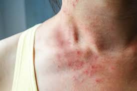 Pastikan juga tidak tidur siang karena dapat mengurangi rasa kantuk di malam hari. 8 Cara Mengatasi Ruam Kulit Ampuh Dan Bisa Dilakukan Di Rumah