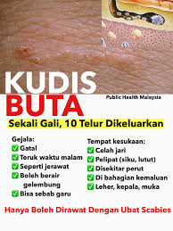 Masalahnya ialah saya sering menggaru ketiak saya dan ketiak saya menjadi hitam, sila terima penyelesaiannya. Public Health Malaysia Ruam Ni Gatal Sungguh Malam Malam Lagi Teruk Gatalnya Sampai Susah Betul Nak Tidur Ingat Ruam Ni Macam Allergik Biasa Tapi Terjangkit Pula Pada Orang Rumah Dah Cuba Macam Macam