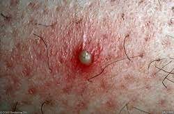Staphylococcus aureus causes a variety of manifestations and diseases. Piodermiti