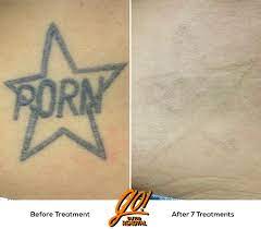 Heavily Scarred Tattoo Removal Results Read Comment For More Info Tattooremoval