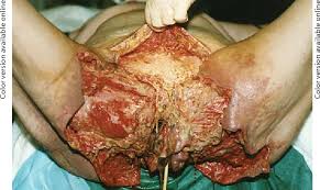 Buck talks through a procedure he recently had to do on a patient with fournier gangrene. Figure 2 From Fournier S Gangrene A Urologic And Surgical Emergency Presentation Of A Multi Institutional Experience With 45 Cases Semantic Scholar