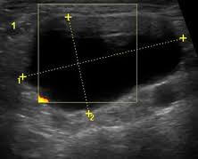 If left unchecked, the cancer can break out of the lymph node and spread to the surrounding. Non Thyroid Cystic Masses Identified On Neck Ultrasound