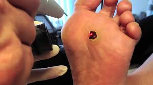 Comment retrouver des pieds de toute beauté ? Comment Enlever Un Durillon Sous La Plante Des Pieds