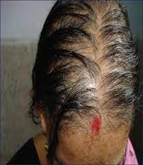 Zinc deficiency can cause similar hair loss to iron and may also damage any remaining hair, causing it to break. Zinc Deficiency Associated With Hypothyroidism An Overlooked Cause Of Severe Alopecia Betsy A Binitha M P Sarita S Int J Trichol