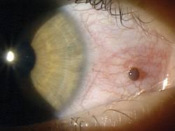Image result for Conjunctival Foreign Body