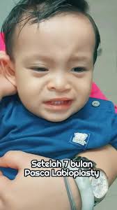 Perawatan dan Revisi Bekas Operasi Bibir Sumbing