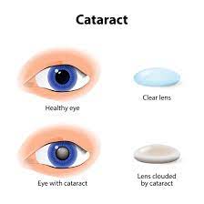 Submit your manuscript to this special issue published by journal of ophthalmology. Vision After Cataract Surgery Elmquist Eye Group Fort Myers Cape Coral Florida